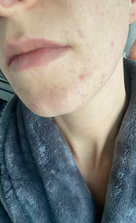 Hormonal Acne after