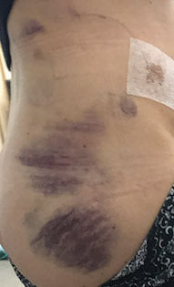 bruising after surgery before